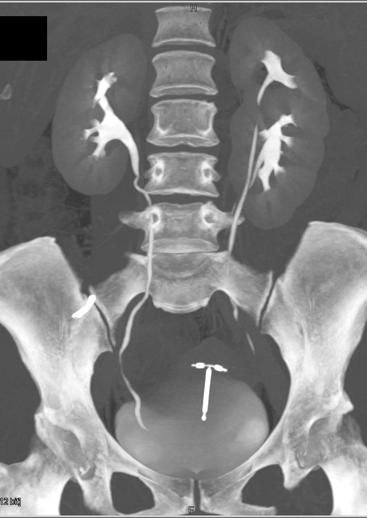 Duplicated Collecting System Left Kidney with an Incidental Left 1 cm