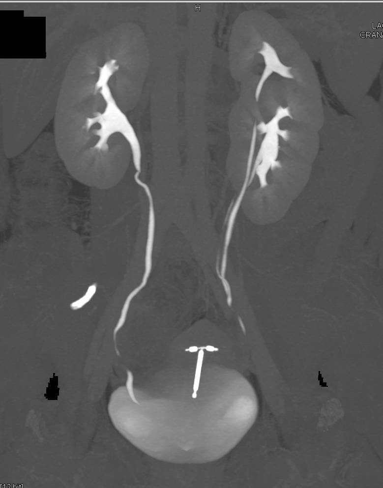 Multiple Left Renal Arteries and Duplication of the Left  Collecting System - CTisus CT Scan