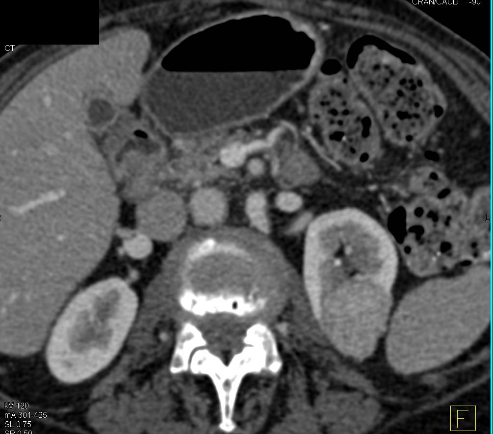 Bilateral Renal Cell Carcinomas - CTisus CT Scan
