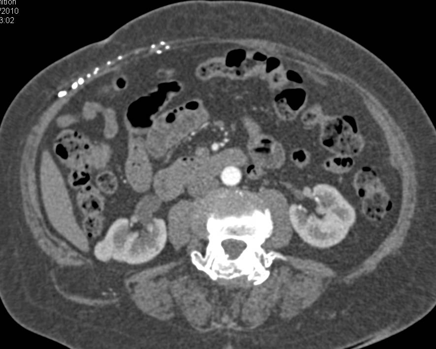 2 cm Right Papillary Renal Cell Carcinoma in Right Kidney - CTisus CT Scan
