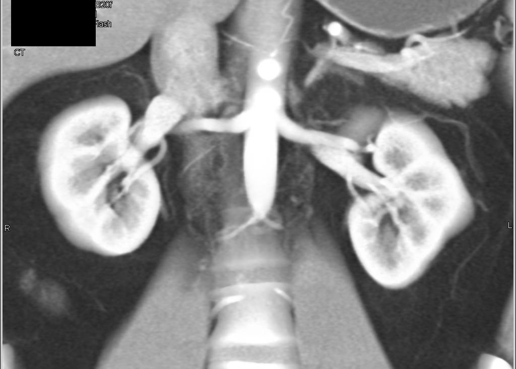 Prehilar Branching of the Left Renal Artery in a Potential Renal Donor - CTisus CT Scan