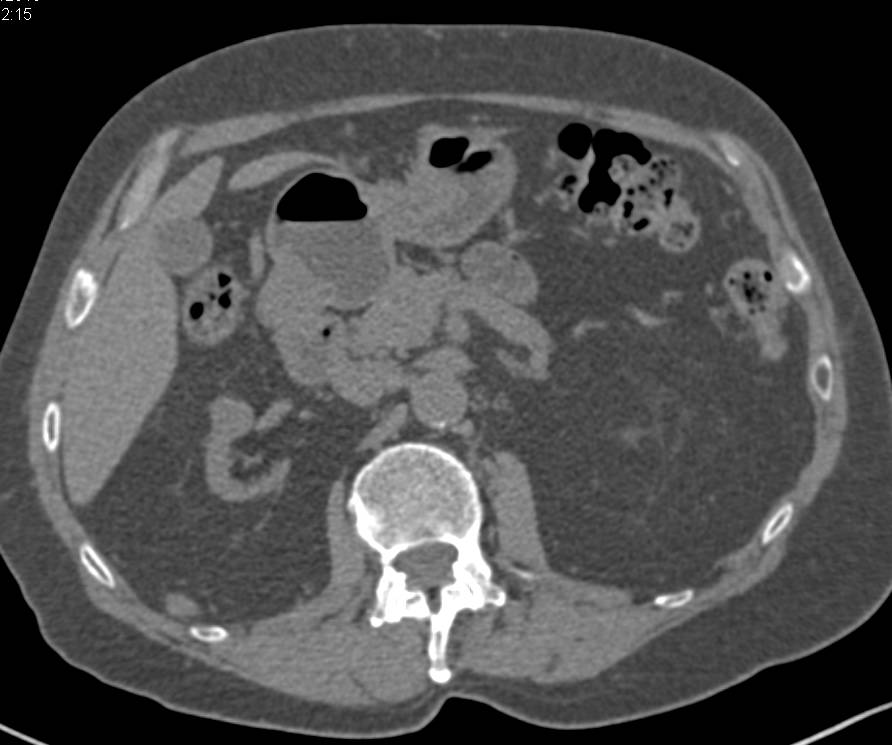 End Stage Renal Disease with a Renal Transplant and now a 1 cm Renal Cell Carcinoma in the Native Right Kidney - CTisus CT Scan
