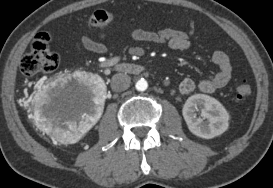 Renal Cell Carcinoma Metastatic to the Pancreas with Neovascularity - CTisus CT Scan