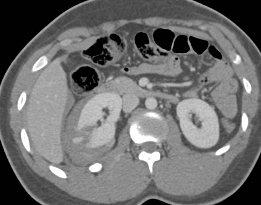 Renal Laceration with Perirenal Blood - CTisus CT Scan