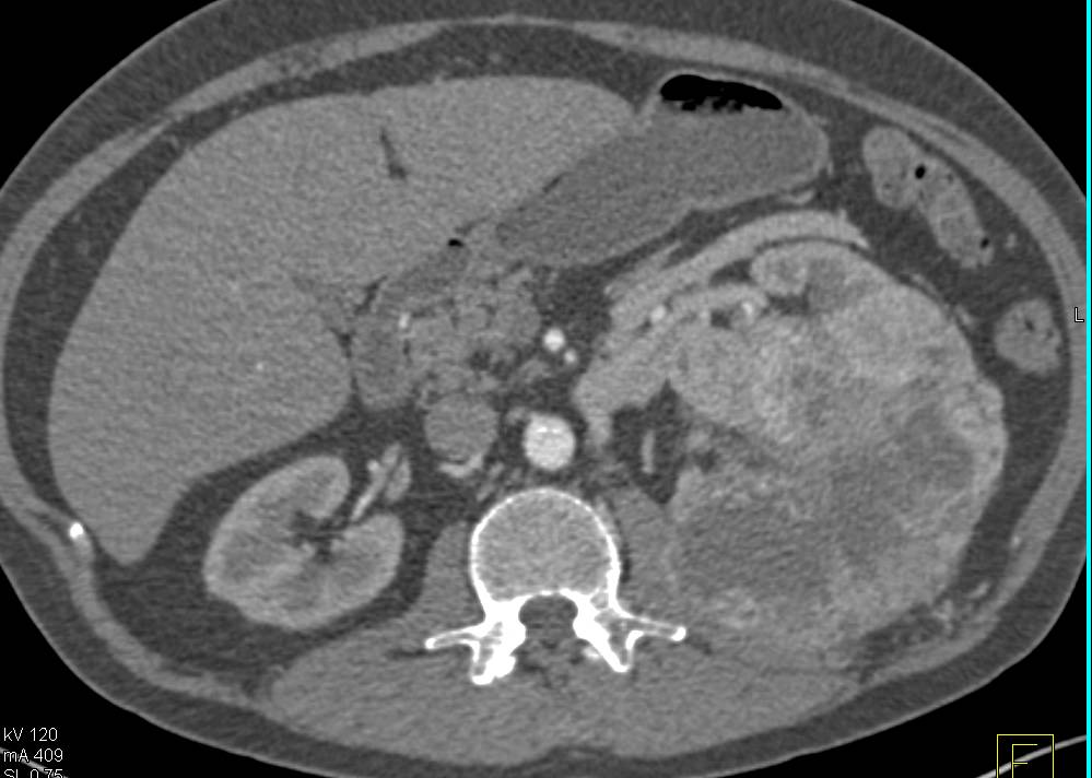 Clear Cell Renal Carcinoma with Involvement of the Psoas Muscle - CTisus CT Scan