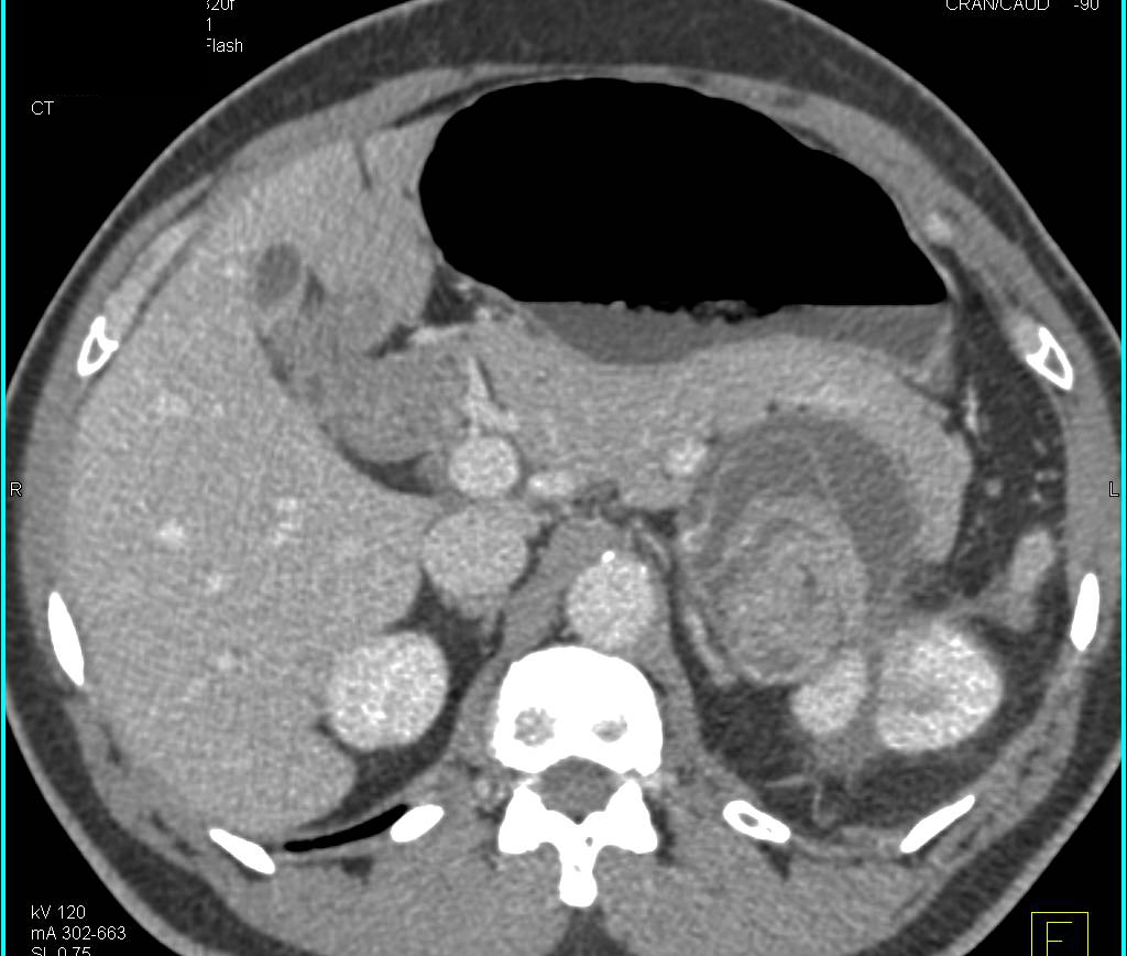 Retained Sponge Simulates Recurrence or Post Operative Abscess in Patient with Partial Nephrectomy - CTisus CT Scan