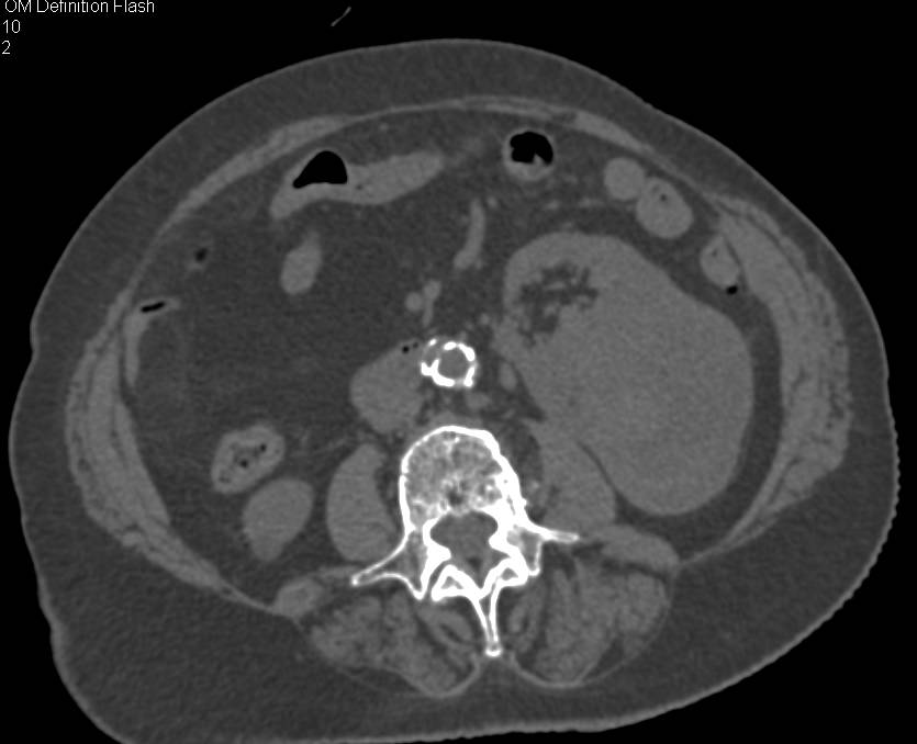 Renal Cell Carcinoma Extends into the Left Renal Vein - CTisus CT Scan