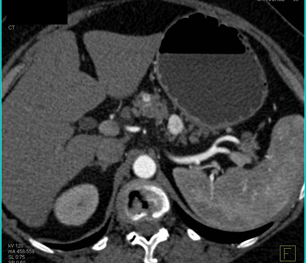 Recurrent Renal Cell Carcinoma Metastatic to the Pancreas with Multifocal Disease and Vascular Metastases - CTisus CT Scan