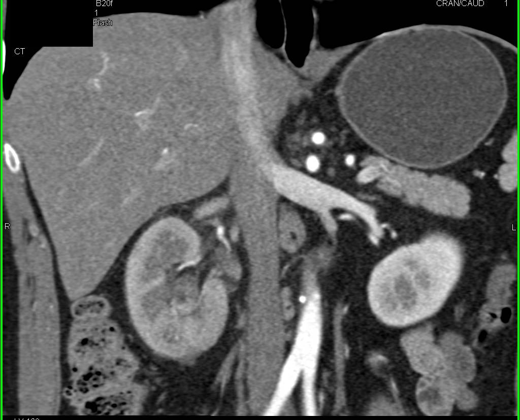 Vascular Renal Cell Carcinoma - CTisus CT Scan