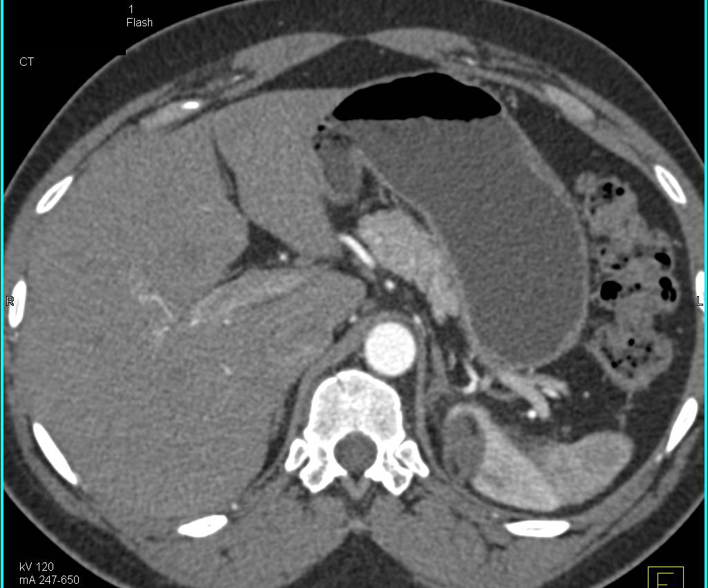 Right Nephrectomy for Renal Cell Carcinoma with Tumor in Contralateral Kidney - CTisus CT Scan
