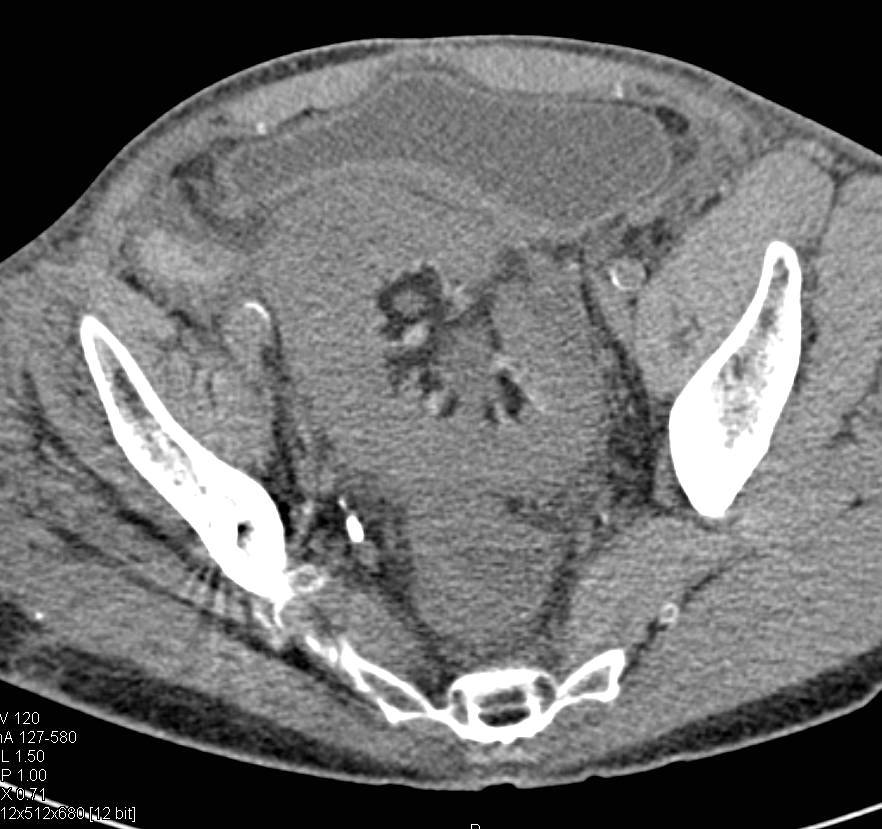 Infarcted Renal Transplant Twisted on its Pedicle and is Ischemic. Pre-Infarcted Images Also Seen. - CTisus CT Scan