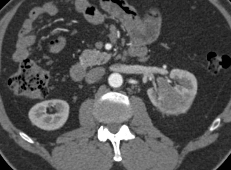 Transitional Cell Carcinoma of the Left Kidney - CTisus CT Scan