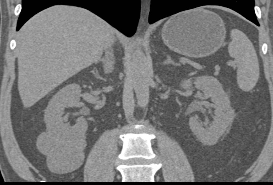 Complex Right Renal Cyst (Bosniak II) - CTisus CT Scan