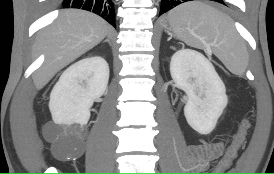 Bosniak II Renal Cyst - CTisus CT Scan