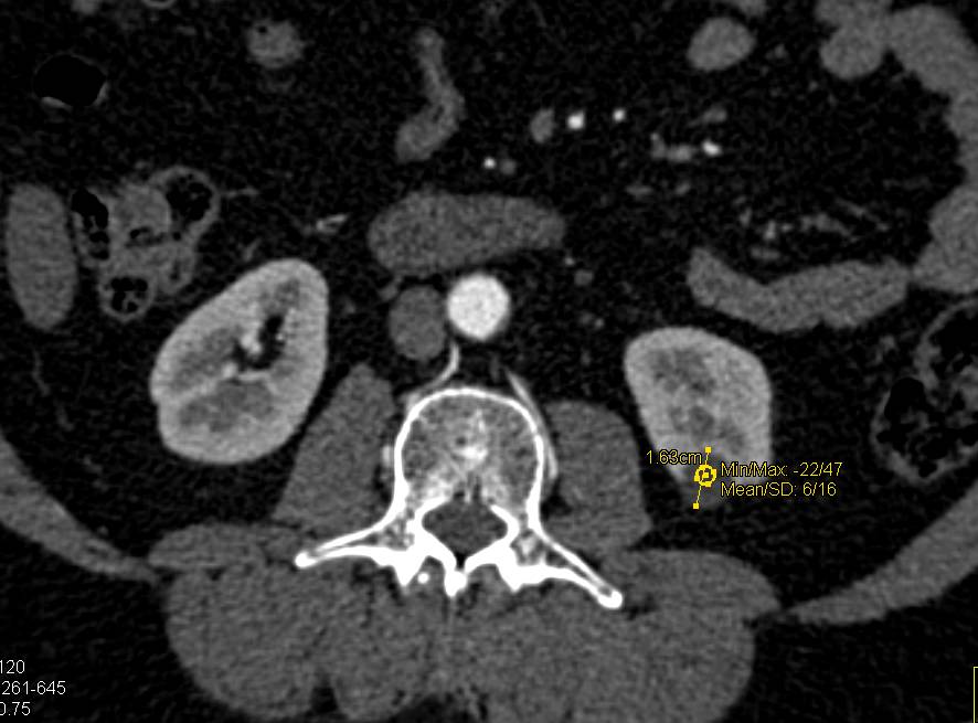 Bosniak I Renal Cyst - CTisus CT Scan