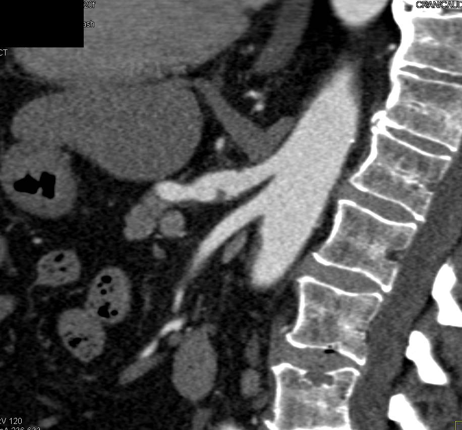 Successful Radiofrequency Ablation (RFA) of a Left Renal Mass and now has Unexpected Finding--Focal Celiac Artery Dissection - CTisus CT Scan