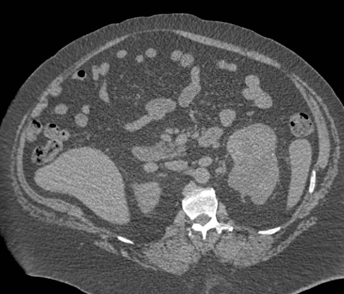 Renal Cell Carcinoma - CTisus CT Scan