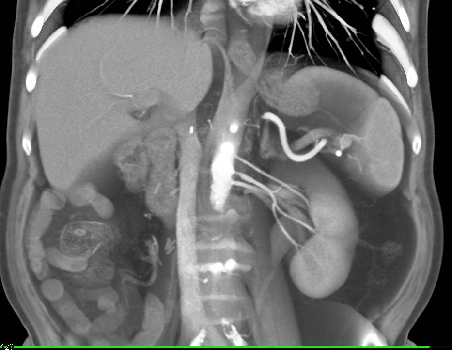 Three Left Renal Arteries with Stenosis in Middle Artery - CTisus CT Scan