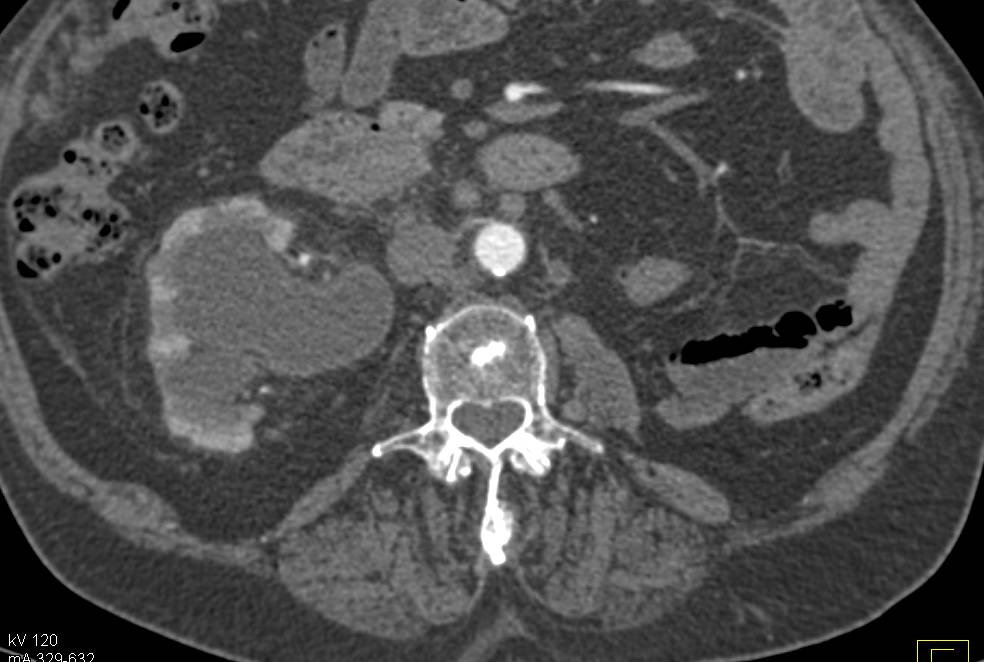 Right Hydronephrosis due to Bladder Cancer - CTisus CT Scan