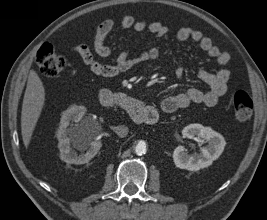 Transitional Cell Carcinoma of the Distal Right Ureter Obstructing the Right Kidney - CTisus CT Scan