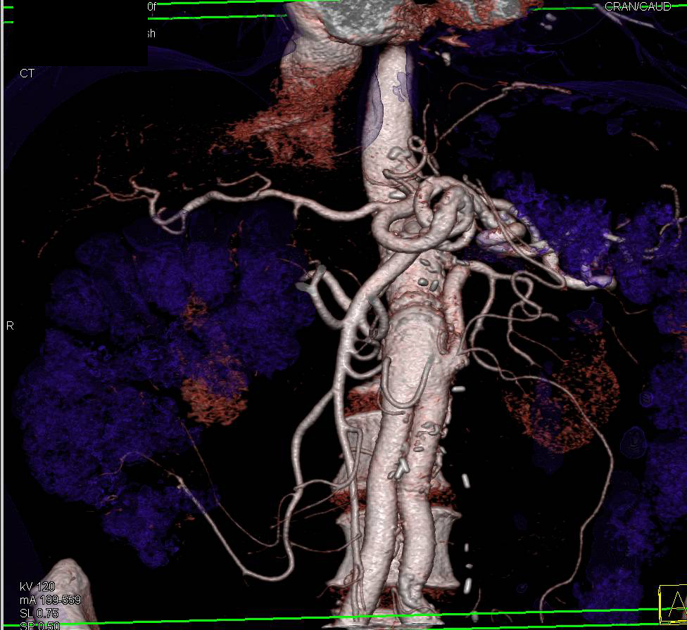 Aortic Aneurysm Repair with Graft to Left Kidney as Reimplanted Left Renal Artery - CTisus CT Scan