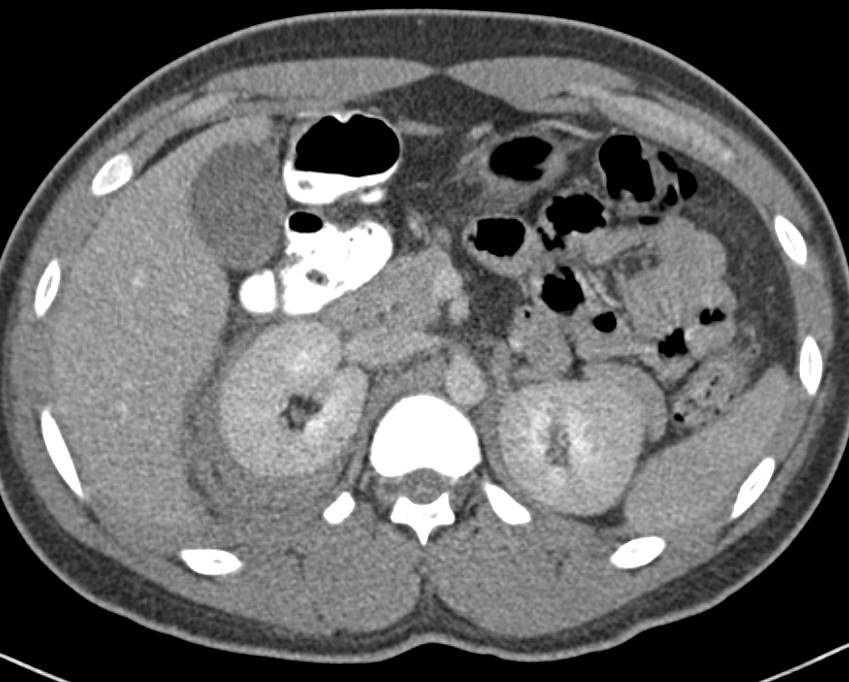 Renal Laceration with Contrast Extravasation from the Renal Pelvis on Delayed Phase Images - CTisus CT Scan