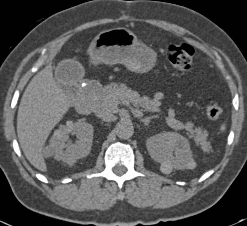 Multiple High Density Renal Cysts - CTisus CT Scan