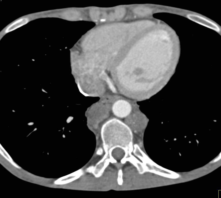 Cystic Metastases due to Metastatic Renal Cell Carcinoma - CTisus CT Scan