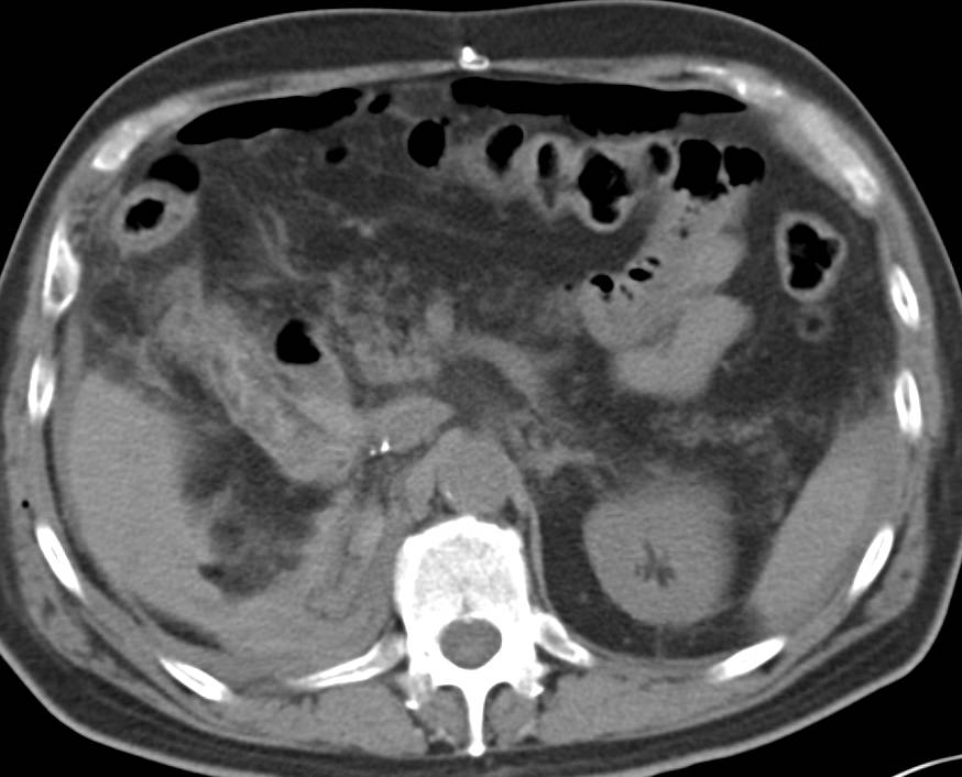 Bleed in Right Renal Fossa Following Laparoscopic Nephrectomy. Pneumoperitoneum Also Seen - CTisus CT Scan