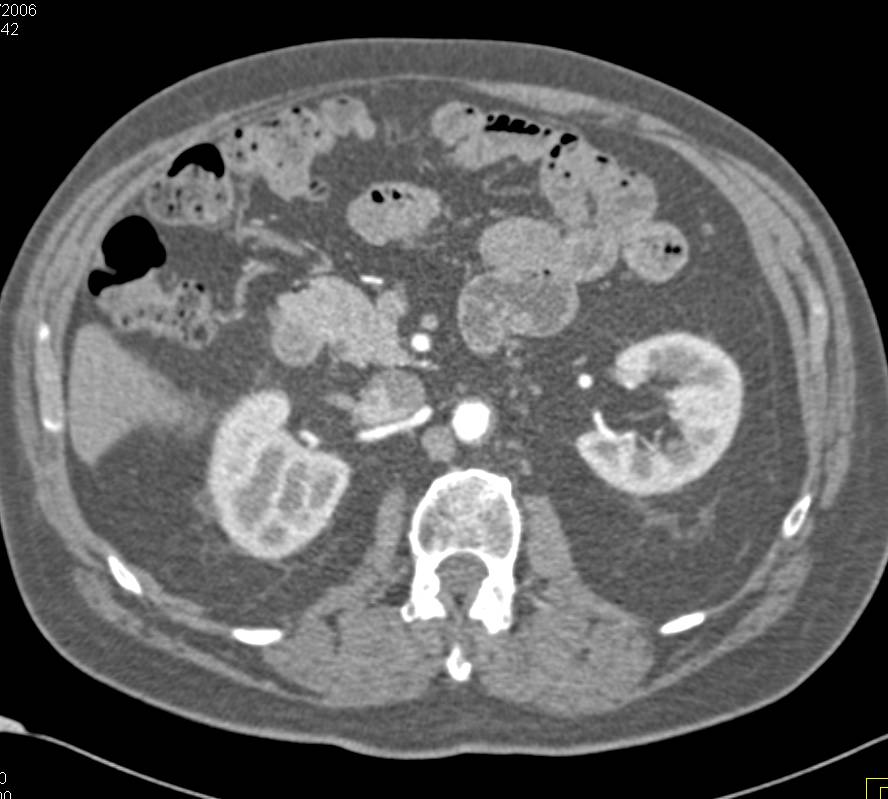 Transitional Cell Carcinoma Right Renal Pelvis - CTisus CT Scan