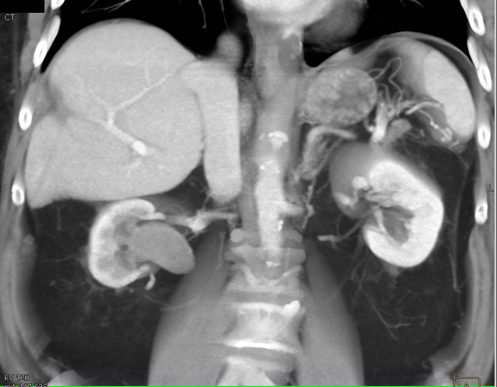 Transitional Cell Carcinoma of the Right Renal Pelvis - CTisus CT Scan