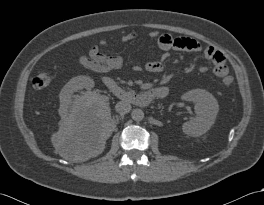Clear Cell Renal Cell Carcinoma with Neovascularity and Perirenal Collaterals - CTisus CT Scan