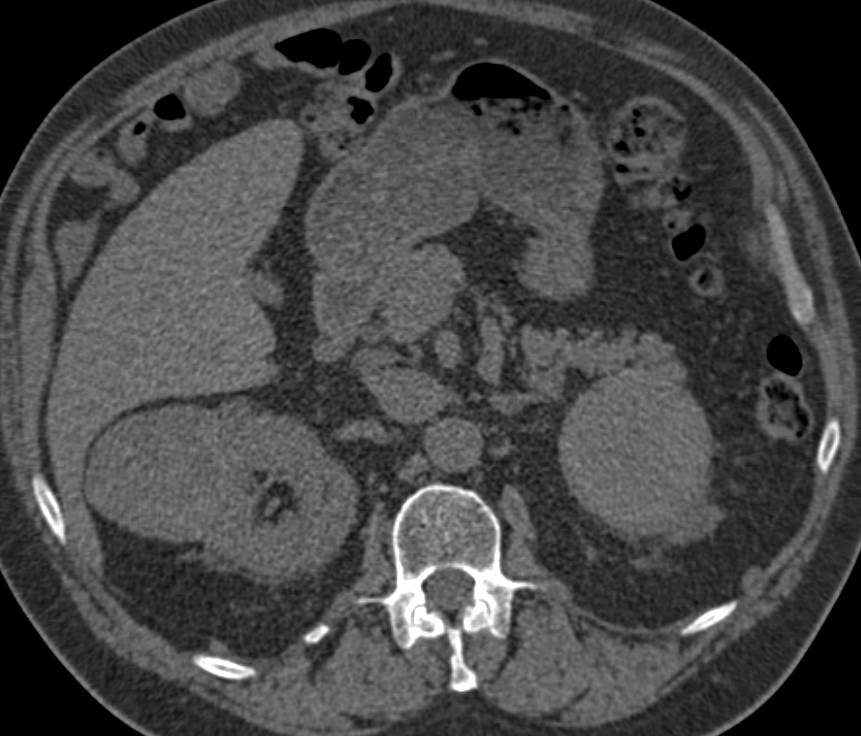 Bilateral Renal Cell Carcinomas - CTisus CT Scan