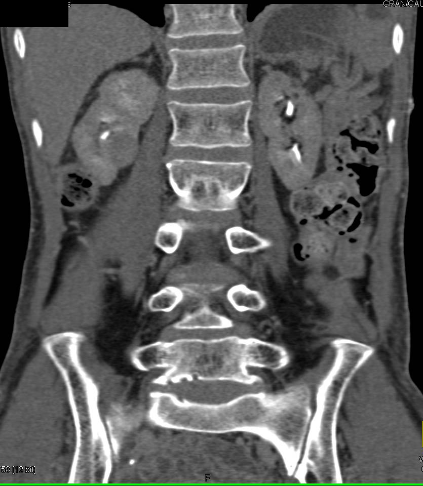 2 cm Papillary Renal Cell Carcinoma in Right Kidney - CTisus CT Scan