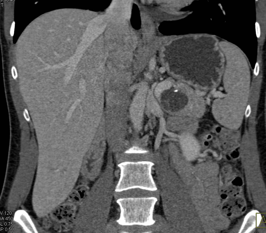 Pseudocyst Adjacent to the Left Kidney - CTisus CT Scan