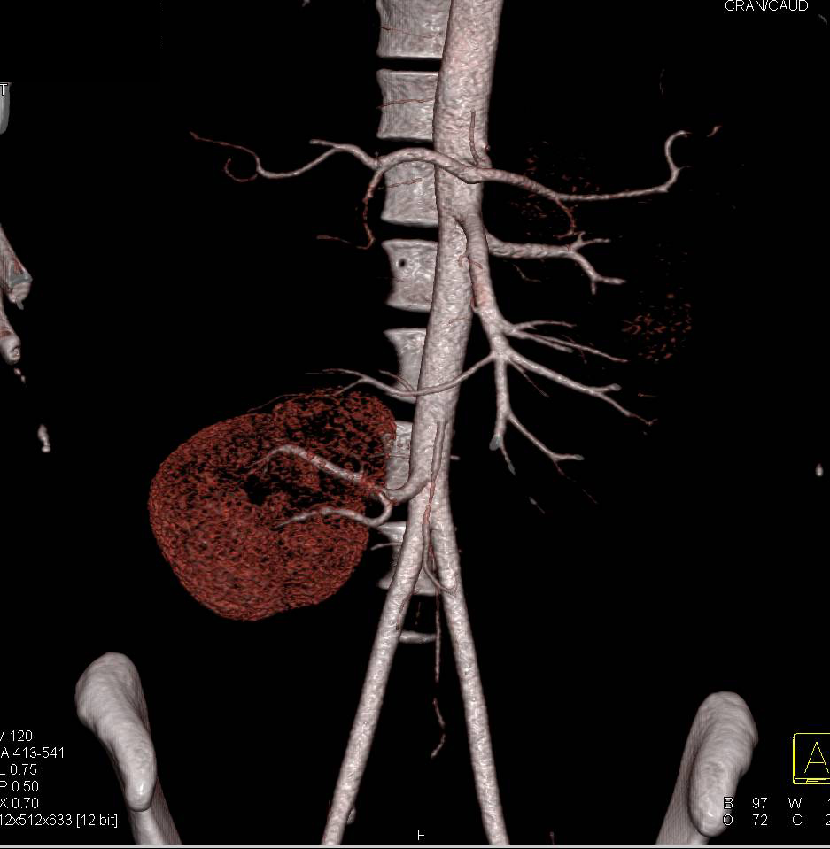 Low Lying Right Kidney with Renal Artery off Iliac Artery - CTisus CT Scan