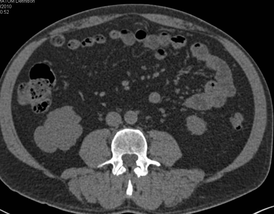 Bosniak II Right Renal Cyst with Thin Septations - CTisus CT Scan