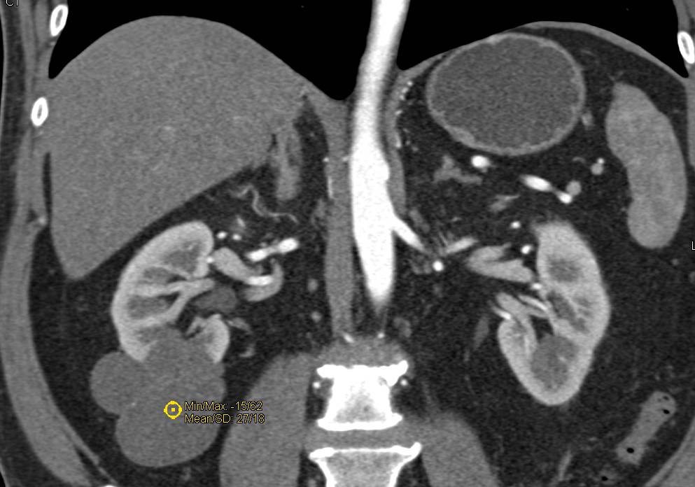 Bosniak II Right Renal Cyst with Thin Septations - Kidney Case Studies ...