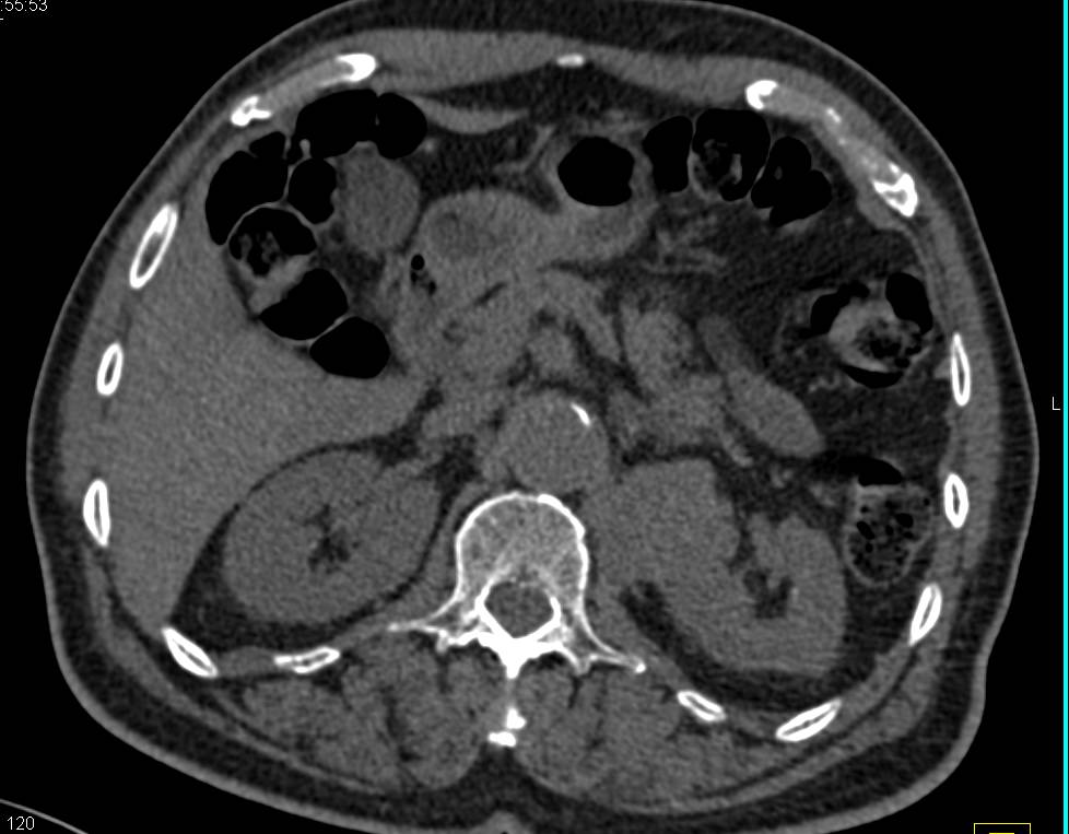Papillary Renal Cell Carcinoma with Mild Enhancement - CTisus CT Scan
