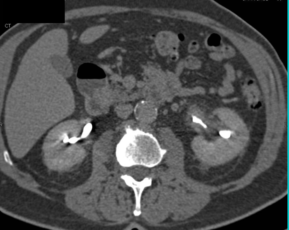 Infiltrating Transitional Cell Carcinoma Left Kidney - CTisus CT Scan
