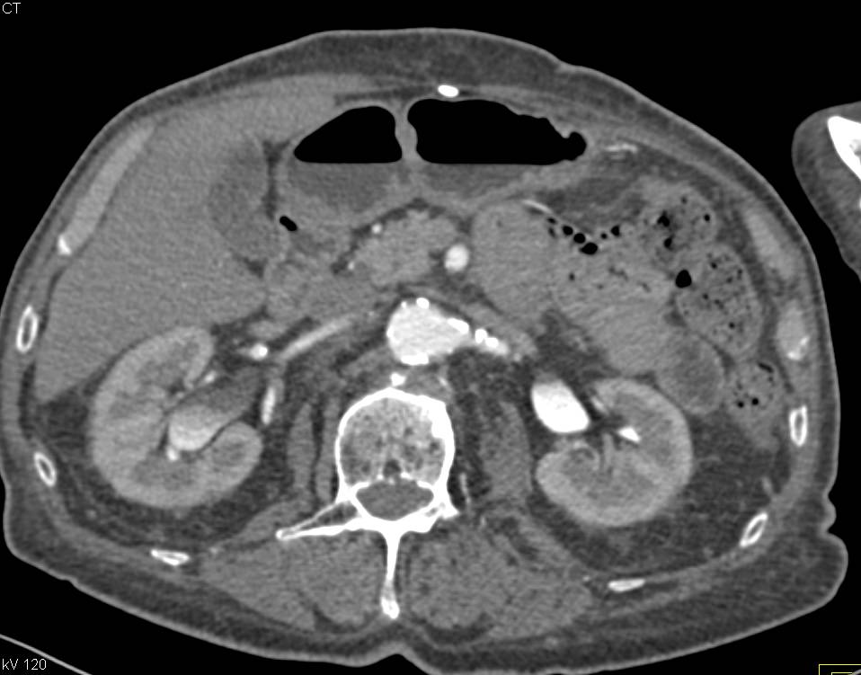 Right Hydronephrosis due to Bladder Cancer - CTisus CT Scan