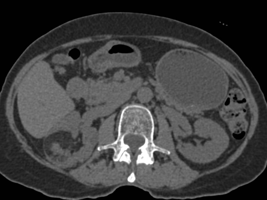 Bilateral Renal Angiomyolipomas with Variable Amounts of Fat - CTisus CT Scan
