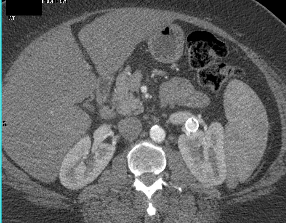 Bilateral Renal Artery Aneurysms - CTisus CT Scan