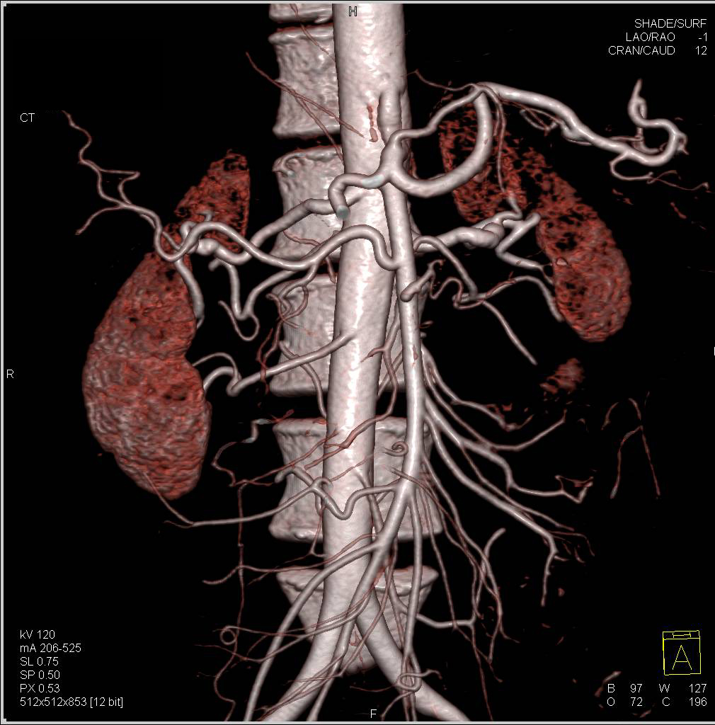 Three Right and Two Left Renal Arteries - CTisus CT Scan