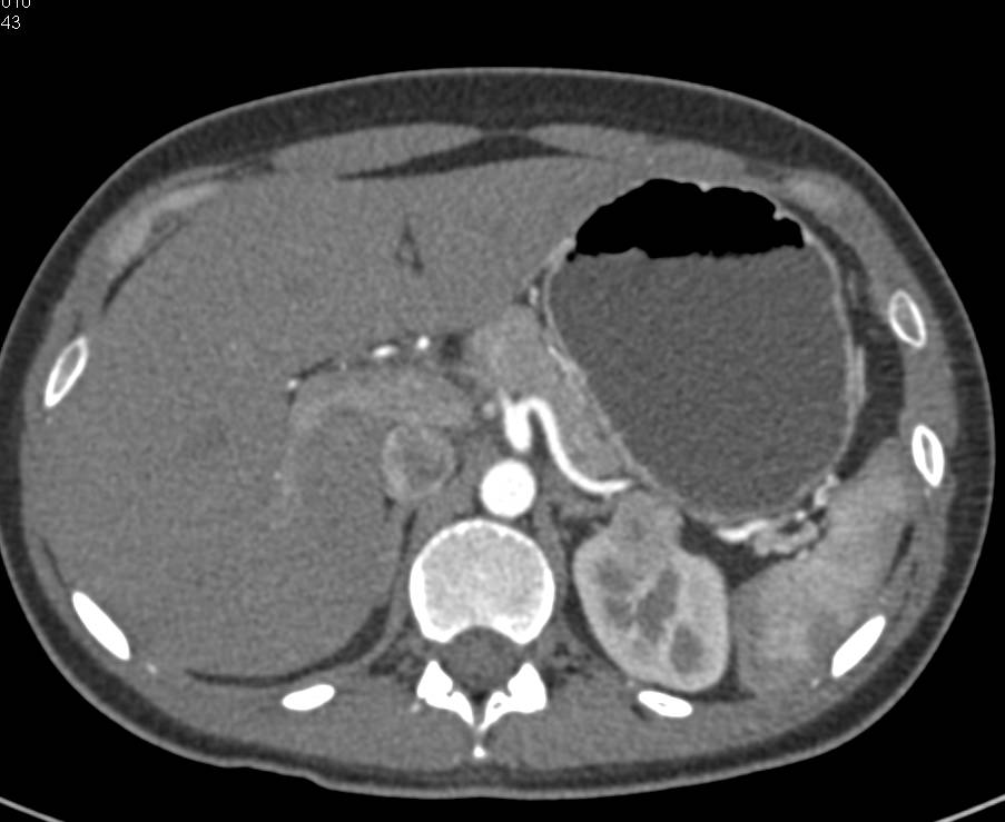 Papillary Renal Cell Carcinoma Left Kidney - CTisus CT Scan