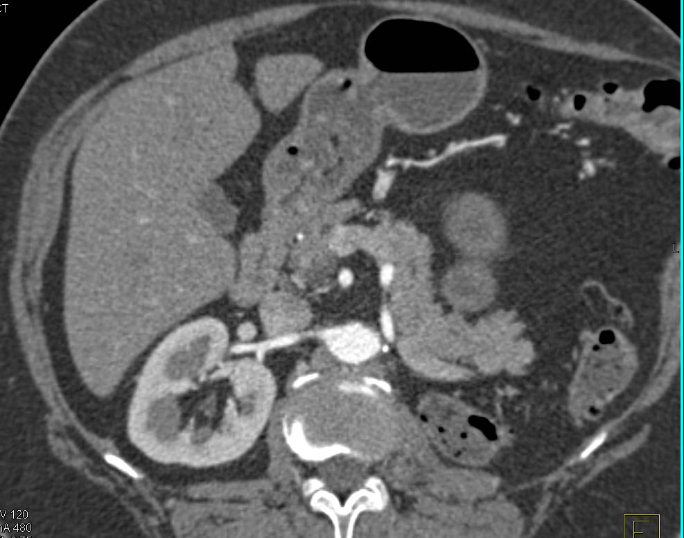 Left Nephrectomy for Renal Cell Carcinoma with Recurrence in the Left Psoas Muscle - CTisus CT Scan