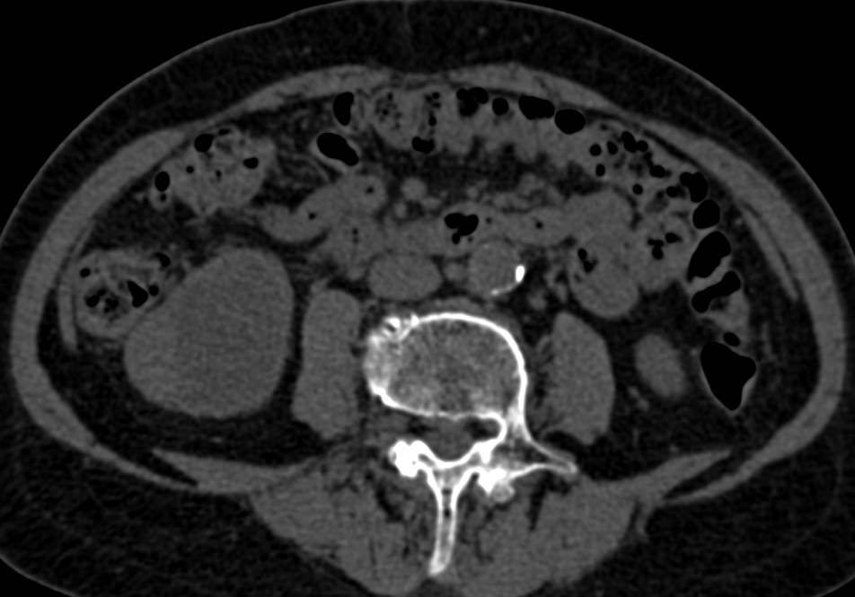 Papillary Renal Cell Carcinoma Right Kidney with Tumor Vascularity - CTisus CT Scan