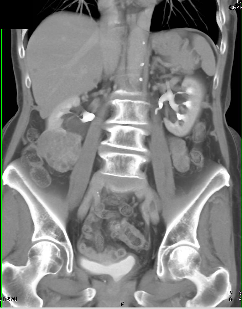 Papillary Renal Cell Carcinoma Right Kidney - CTisus CT Scan