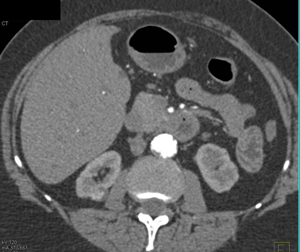 2 cm Right Papillary renal Cell Carcinoma Easy to Miss Because of Multiole Renal Cysts - CTisus CT Scan