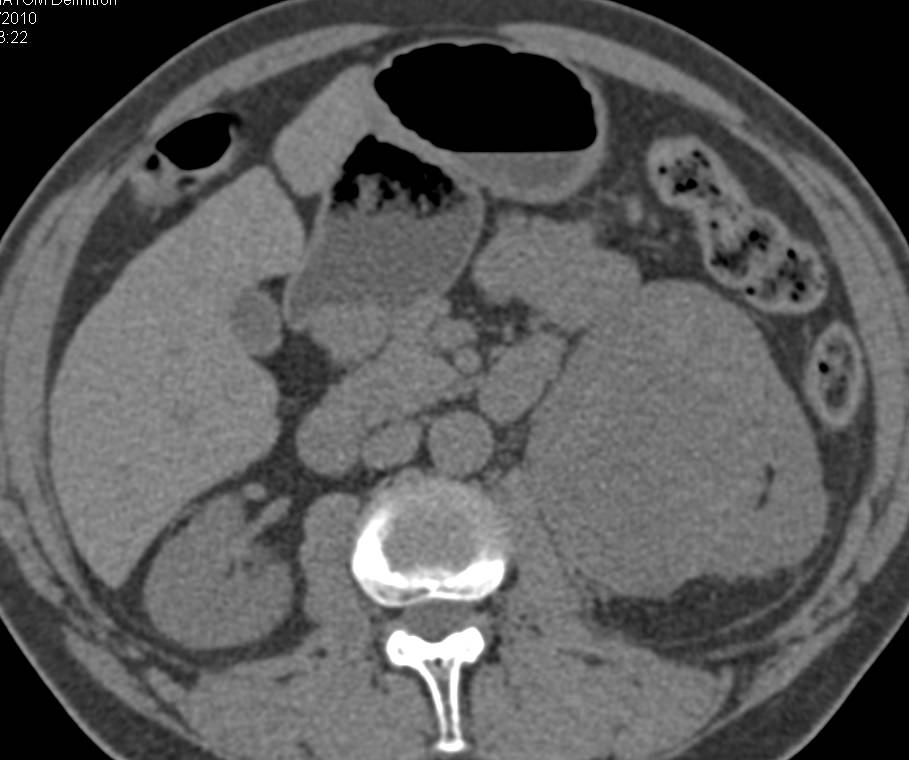 Papillary Renal Cell Carcinoma with Mild Enhancement - CTisus CT Scan